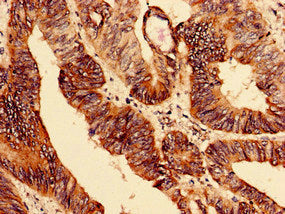 Immunohistochemistry analysis of  human colon cancer using ELAVL2 Antibody at dilution of 1:100Rabbit anti-Human ELAVL2 Polyclonal Antibody