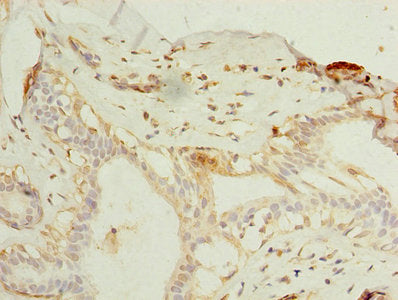 Immunohistochemistry of paraffin-embedded human breast cancer using ELAVL4 Antibody at dilution of 1:100Rabbit anti-Human ELAVL4 Polyclonal Antibody