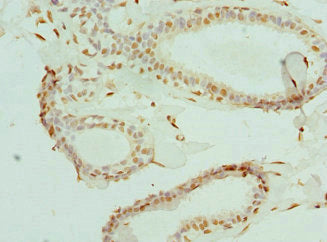 Immunohistochemistry of paraffin-embedded human breast cancer using ELF1 Antibody at dilution of 1:100Rabbit anti-Human ELF1 Polyclonal Antibody