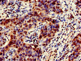 Immunohistochemistry of paraffin-embedded human bladder cancer using EMD Antibody at dilution of 1:100Rabbit anti-Human EMD Polyclonal Antibody