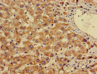 Immunohistochemistry of paraffin-embedded human liver cancer using EN2 Antibody at dilution of 1:100Rabbit anti-Human EN2 Polyclonal Antibody