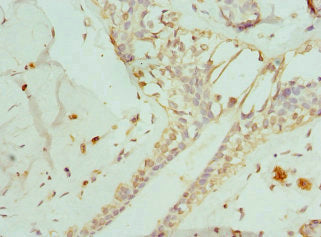 Immunohistochemistry of paraffin-embedded human breast cancer using ENTPD2 Antibody at dilution of 1:100Rabbit anti-Human ENTPD2 Polyclonal Antibody