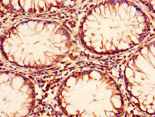 Immunohistochemistry of paraffin-embedded human colon cancer using ENTPD8 Antibody at dilution of 1:100Rabbit anti-Human ENTPD8 Polyclonal Antibody