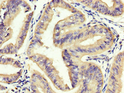 IHC image of EOMES Antibody diluted at 1:400 and staining in paraffin-embedded human endometrial cancer performed on a Leica BondTM system. After dewaxing and hydration, antigen retrieval was mediated by high pressure in a citrate buffer (pH 6.0). Section was blocked with 10% normal goat serum 30min at RT. Then primary antibody (1% BSA) was incubated at 4°C overnight. The primary is detected by a biotinylated secondary antibody and visualized using an HRP conjugated SP system.Rabbit anti-Human EOMES Polyclonal Antibody