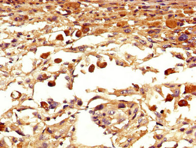 IHC image of EOMES Antibody diluted at 1:400 and staining in paraffin-embedded human melanoma performed on a Leica BondTM system. After dewaxing and hydration, antigen retrieval was mediated by high pressure in a citrate buffer (pH 6.0). Section was blocked with 10% normal goat serum 30min at RT. Then primary antibody (1% BSA) was incubated at 4°C overnight. The primary is detected by a biotinylated secondary antibody and visualized using an HRP conjugated SP system.Rabbit anti-Human EOMES Polyclonal Antibody