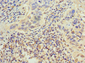 Immunohistochemistry of paraffin-embedded human bladder cancer using the antibody at dilution of 1:100Rabbit anti-Human EP300 Polyclonal Antibody