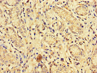 Immunohistochemistry of paraffin-embedded human gastric cancer using EPHA1 Antibody at dilution of 1:100