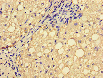 Immunohistochemistry of paraffin-embedded human liver cancer using EPHA1 Antibody at dilution of 1:100
