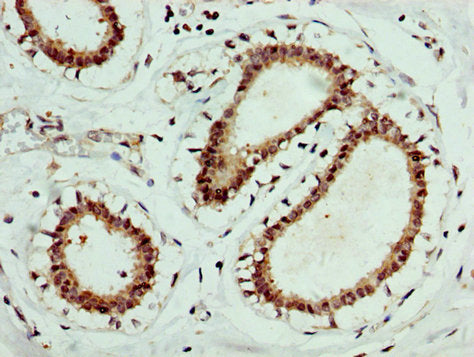 IHC image of EPOR Antibody diluted at 1:400 and staining in paraffin-embedded human breast cancer performed on a Leica BondTM system. After dewaxing and hydration, antigen retrieval was mediated by high pressure in a citrate buffer (pH 6.0). Section was blocked with 10% normal goat serum 30min at RT. Then primary antibody (1% BSA) was incubated at 4°C overnight. The primary is detected by a biotinylated secondary antibody and visualized using an HRP conjugated SP system.Rabbit anti-Human EPOR Polyclonal Antibody