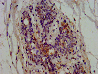 IHC image of EPRS Antibody diluted at 1:600 and staining in paraffin-embedded human breast cancer performed on a Leica BondTM system. After dewaxing and hydration, antigen retrieval was mediated by high pressure in a citrate buffer (pH 6.0). Section was blocked with 10% normal goat serum 30min at RT. Then primary antibody (1% BSA) was incubated at 4°C overnight. The primary is detected by a biotinylated secondary antibody and visualized using an HRP conjugated SP system.Rabbit anti-Human EPRS Polyclonal Antibody