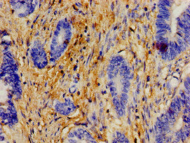 Immunohistochemistry of paraffin-embedded human colon cancer using the antibody at dilution of 1:100Rabbit anti-Human ERAL1 Polyclonal Antibody