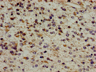 Immunohistochemistry of paraffin-embedded human glioma using ERAL1 Antibody at dilution of 1:100Rabbit anti-Human ERAL1 Polyclonal Antibody