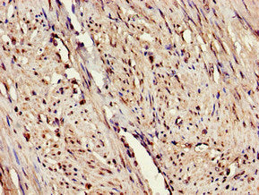 Immunohistochemistry of paraffin-embedded human endometrial cancer using the antibody at dilution of 1:100Rabbit anti-Human ERAP1 Polyclonal Antibody