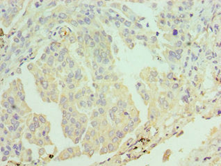 Immunohistochemistry of paraffin-embedded human lung cancer using ERCC2 Antibody at dilution of 1:100Rabbit anti-Human ERCC2 Polyclonal Antibody