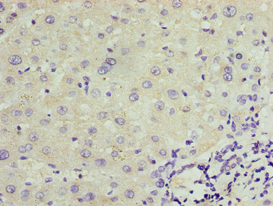Immunohistochemistry of paraffin-embedded human liver cancer using TRPM2 Antibody at dilution of 1:100Rabbit anti-Human TRPM2 Polyclonal Antibody