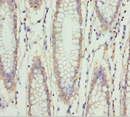 Immunohistochemistry of paraffin-embedded human colon cancer using ERLIN2 Antibody at dilution of 1:100Rabbit anti-Human ERLIN2 Polyclonal Antibody