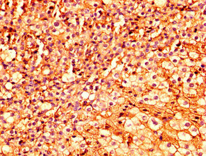 IHC image of ESRP2 Antibody diluted at 1:300 and staining in paraffin-embedded human adrenal gland tissue performed on a Leica BondTM system. After dewaxing and hydration, antigen retrieval was mediated by high pressure in a citrate buffer (pH 6.0). Section was blocked with 10% normal goat serum 30min at RT. Then primary antibody (1% BSA) was incubated at 4°C overnight. The primary is detected by a biotinylated secondary antibody and visualized using an HRP conjugated SP system.Rabbit anti-Human ESRP2 Polyclonal Antibody
