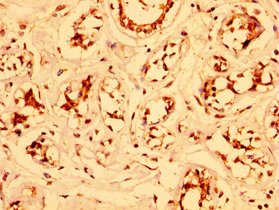 IHC image of ESRP2 Antibody diluted at 1:300 and staining in paraffin-embedded human breast cancer performed on a Leica BondTM system. After dewaxing and hydration, antigen retrieval was mediated by high pressure in a citrate buffer (pH 6.0). Section was blocked with 10% normal goat serum 30min at RT. Then primary antibody (1% BSA) was incubated at 4°C overnight. The primary is detected by a biotinylated secondary antibody and visualized using an HRP conjugated SP system.Rabbit anti-Human ESRP2 Polyclonal Antibody