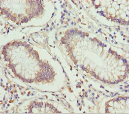 Immunohistochemistry of paraffin-embedded human colon cancer using ETFA Antibody at dilution of 1:100Rabbit anti-Human ETFA Polyclonal Antibody