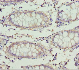 Immunohistochemistry of paraffin-embedded human colon cancer using ETFA Antibody at dilution of 1:100Rabbit anti-Human ETFA Polyclonal Antibody