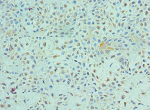 Immunohistochemistry of paraffin-embedded human breast cancer using the antibody at dilution of 1:100Rabbit anti-Human ETV6 Polyclonal Antibody