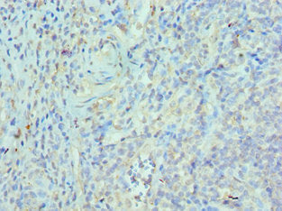 Immunohistochemistry of paraffin-embedded human epityphlon tissue using ETV6 Antibody at dilution of 1:100Rabbit anti-Human ETV6 Polyclonal Antibody