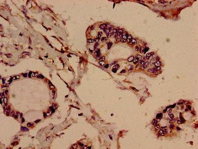 Immunohistochemistry analysis of human pancreatic cancer using EVC Antibody at dilution of 1:100Rabbit anti-Human EVC Polyclonal Antibody