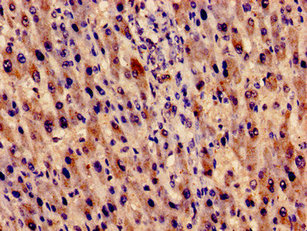 Immunocytochemistry analysis of human liver cancer using EVC Antibody at dilution of 1:100Rabbit anti-Human EVC Polyclonal Antibody