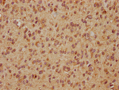 IHC image of the antibody diluted at 1:560 and staining in paraffin-embedded human glioma cancer performed on a Leica BondTM system. After dewaxing and hydration, antigen retrieval was mediated by high pressure in a citrate buffer (pH 6.0). Section was blocked with 10% normal goat serum 30min at RT. Then primary antibody (1% BSA) was incubated at 4°C overnight. The primary is detected by a biotinylated secondary antibody and visualized using an HRP conjugated SP system.Rabbit anti-Human EXOC7 Polyclonal Antibody