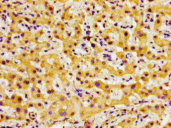Immunohistochemistry of paraffin-embedded human liver cancer using the antibody at dilution of 1:100Rabbit anti-Human F13A1 Polyclonal Antibody