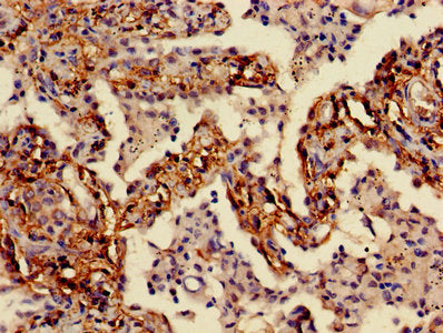 Immunohistochemistry of paraffin-embedded human lung cancer using F3 Antibody at dilution of 1:100Rabbit anti-Human F3 Polyclonal Antibody