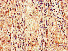 Immunohistochemistry of paraffin-embedded human liver cancer using F9 Antibody at dilution of 1:100Rabbit anti-Human F9 Polyclonal Antibody