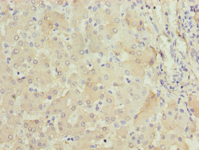 Immunohistochemistry of paraffin-embedded human liver tissue using FABP1 Antibody at dilution of 1:100Rabbit anti-Human FABP1 Polyclonal Antibody