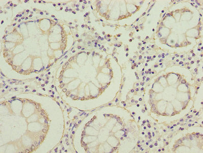 Immunohistochemistry of paraffin-embedded human colon cancer using FABP1 Antibody at dilution of 1:100Rabbit anti-Human FABP1 Polyclonal Antibody
