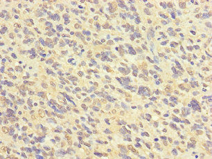 Immunohistochemistry of paraffin-embedded human glioma using FABP7 Antibody at dilution of 1:100Rabbit anti-Human FABP7 Polyclonal Antibody