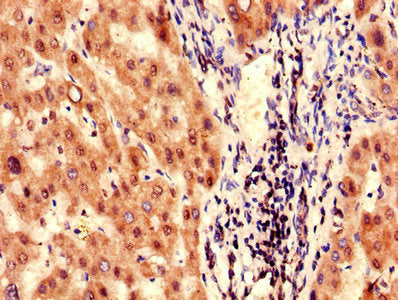 Immunohistochemistry of paraffin-embedded human liver tissue using FAH Antibody at dilution of 1:100Rabbit anti-Human FAH Polyclonal Antibody