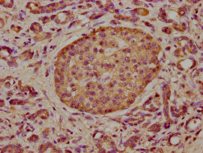IHC image of the antibody diluted at 1:300 and staining in paraffin-embedded human pancreatic cancer performed on a Leica BondTM system. After dewaxing and hydration, antigen retrieval was mediated by high pressure in a citrate buffer (pH 6.0). Section was blocked with 10% normal goat serum 30min at RT. Then primary antibody (1% BSA) was incubated at 4°C overnight. The primary is detected by a biotinylated secondary antibody and visualized using an HRP conjugated SP system.Rabbit anti-Human TCAF2 Polyclonal Antibody