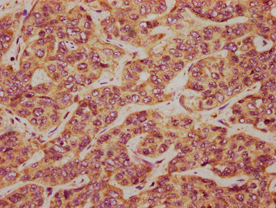 IHC image of TCAF2 Antibody diluted at 1:300 and staining in paraffin-embedded human liver cancer performed on a Leica BondTM system. After dewaxing and hydration, antigen retrieval was mediated by high pressure in a citrate buffer (pH 6.0). Section was blocked with 10% normal goat serum 30min at RT. Then primary antibody (1% BSA) was incubated at 4°C overnight. The primary is detected by a biotinylated secondary antibody and visualized using an HRP conjugated SP system.Rabbit anti-Human TCAF2 Polyclonal Antibody