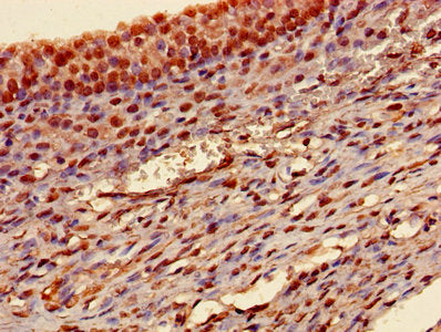 Immunohistochemistry of paraffin-embedded human ovarian cancer using TAGLN Antibody at dilution of 1:100Rabbit anti-Human TAGLN Polyclonal Antibody