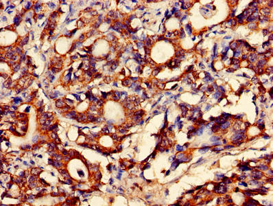Immunohistochemistry of paraffin-embedded human gastric cancer using the antibody at dilution of 1:100Rabbit anti-Human FAM168B Polyclonal Antibody