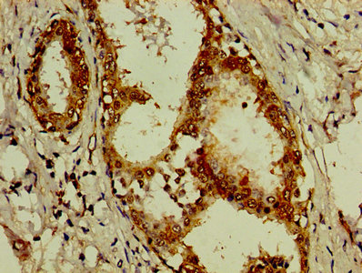 IHC image of ACTN4 Antibody diluted at 1:200 and staining in paraffin-embedded human breast cancer performed on a Leica BondTM system. After dewaxing and hydration, antigen retrieval was mediated by high pressure in a citrate buffer (pH 6.0). Section was blocked with 10% normal goat serum 30min at RT. Then primary antibody (1% BSA) was incubated at 4°C overnight. The primary is detected by a biotinylated secondary antibody and visualized using an HRP conjugated SP system.