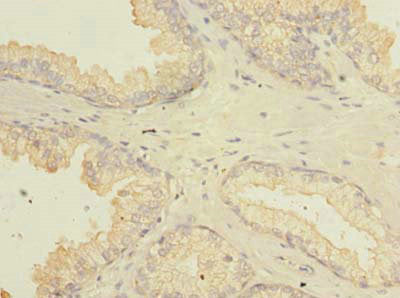 Immunohistochemistry of paraffin-embedded human prostate cancer using FAM92A Antibody at dilution of 1:100Rabbit anti-Human FAM92A Polyclonal Antibody