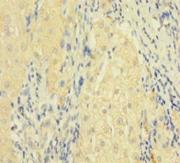 Immunohistochemistry of paraffin-embedded human liver cancer using the antibody at dilution of 1:100Rabbit anti-Human FASLG Polyclonal Antibody