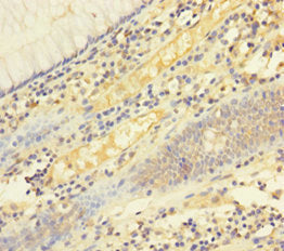 Immunohistochemistry of paraffin-embedded human colon cancer using FASLG Antibody at dilution of 1:100Rabbit anti-Human FASLG Polyclonal Antibody