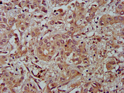 IHC image of FBLN2 Antibody diluted at 1:500 and staining in paraffin-embedded human liver cancer performed on a Leica BondTM system. After dewaxing and hydration, antigen retrieval was mediated by high pressure in a citrate buffer (pH 6.0). Section was blocked with 10% normal goat serum 30min at RT. Then primary antibody (1% BSA) was incubated at 4°C overnight. The primary is detected by a biotinylated secondary antibody and visualized using an HRP conjugated SP system.Rabbit anti-Human FBLN2 Polyclonal Antibody