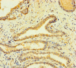 Immunohistochemistry of paraffin-embedded human prostate cancer using the antibody at dilution of 1:100Rabbit anti-Human FCER1A Polyclonal Antibody