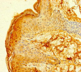 Immunohistochemistry of paraffin-embedded human skin tissue using FCER1A Antibody at dilution of 1:100Rabbit anti-Human FCER1A Polyclonal Antibody