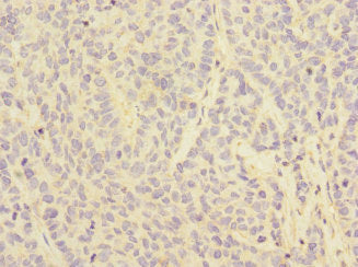 Immunohistochemistry of paraffin-embedded human ovarian cancer using FCGR2C Antibody at dilution of 1:100Rabbit anti-Human FCGR2C Polyclonal Antibody
