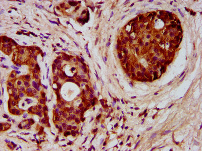 IHC image of the antibody diluted at 1:300 and staining in paraffin-embedded human pancreatic cancer performed on a Leica BondTM system. After dewaxing and hydration, antigen retrieval was mediated by high pressure in a citrate buffer (pH 6.0). Section was blocked with 10% normal goat serum 30min at RT. Then primary antibody (1% BSA) was incubated at 4°C overnight. The primary is detected by a biotinylated secondary antibody and visualized using an HRP conjugated SP system.Rabbit anti-Human FCHO1 Polyclonal Antibody