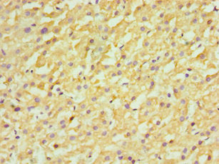 Immunohistochemistry of paraffin-embedded human liver cancer using FDFT1 Antibody at dilution of 1:100